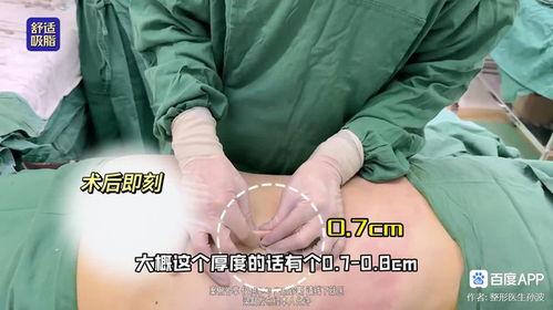 爆料桂哥抽脂视频教程